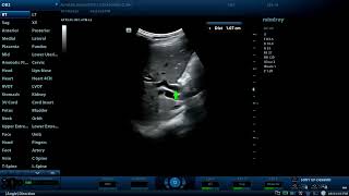 Obstructive jaundice with dilated bile ducts  Diagnostic ultrasound cases [upl. by Breech]