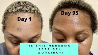 IS THIS MEDERMA WORKING  MEDERMA ADVANCED SCAR GEL 3 MONTH UPDATE  NIJAH J [upl. by Yendis]