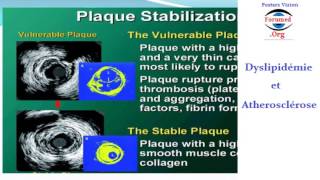 Dyslipidémie par augmentation de taux mauvais Cholesterol et Triglyceride dans Atherosclerose [upl. by Reinaldo228]