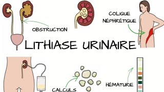 LITHIASE URINAIRE Signes et Symptômes diagnostic traitement  Complications [upl. by Ulrich]