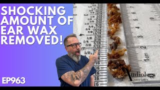 The Most Shocking Ear Wax Removal Ever  EP963 [upl. by Winchester841]