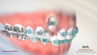 Orthodontic Treatment for Impacted Canine  Laser Exposure [upl. by Hagerman]