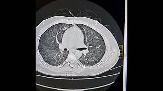 Pneumocystis jirovici pneumonia [upl. by Sayer152]