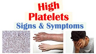 High Platelets Thrombocytosis Signs amp Symptoms  Rapid Review [upl. by Ruthann]