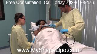 Abdominal Liposuction Smart Lipo MyShape Lipo and Trevor Schmidt PAC [upl. by Urquhart]