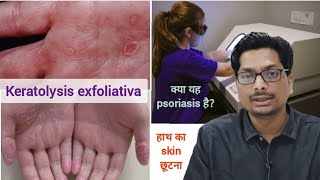 हाथ का skin छूटना  क्या यह psoriasis है Keratolysis exfoliativa  Peeling of hand skin psoriasis [upl. by Eilema850]