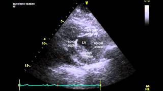 Parasternal short axis PSAX through apex of a normal heart [upl. by Aissirac]