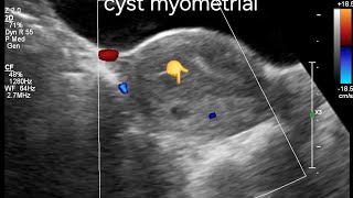 Ultrasound Imaging of Posterior Wall Myometrial Cyst with Adenomyosis Features in a globular Uterus [upl. by Ahsir]