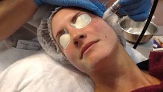 Microdermabrasie behandeling van reviderm [upl. by Manas]