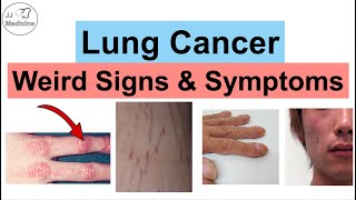 Lung Cancer Weird Signs and Symptoms  Paraneoplastic Syndromes of Lung Cancer [upl. by Colis]