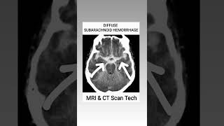 Subarachnoid Hemorrhage CT Scan viral youtubeshorts ct shortsfeed [upl. by Moorefield331]