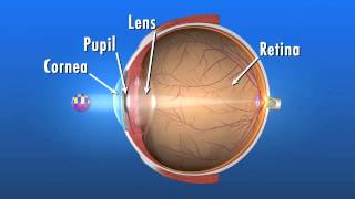 What is a Cataract and how does it affect my vision [upl. by Yssirk940]