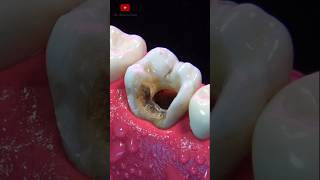 ASOMBROSA restauración dental asmr [upl. by Pirzada]