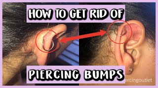 HOW TO GET RID OF PIERCING BUMPS [upl. by Valerie]