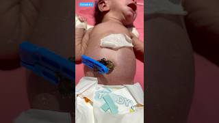 Umbilical Cord Caremedical viralvideo [upl. by Lhadnek]