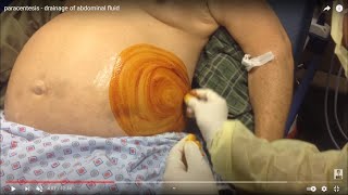 Ascitic fluid tapping technique ASCITIC TAP PROCEDUREPERITONEAL FLUID DRAINAGEABDOMINAL FLUID [upl. by Marabelle]