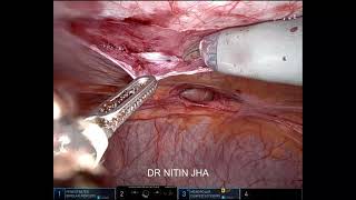 HD4K ROBOTIC Ventral  umbilical hernia repair [upl. by Ruhtracam286]