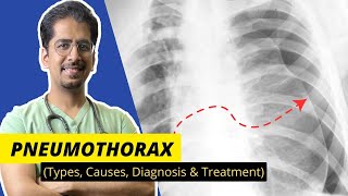 PNEUMOTHORAX Types Causes Diagnosis amp Treatment  Detailed video [upl. by Ecirtac]