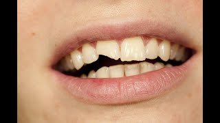 Chipped Tooth Aptos CA 831 2261218 [upl. by Leahcim]