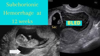 Subchorionic Hemorrhage ultrasound 12 weeks [upl. by Llebpmac342]