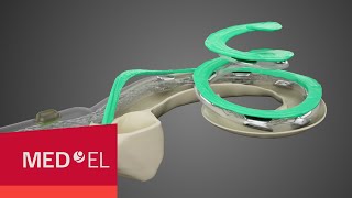 Cochlear Implant Electrodes to Fit Each Cochlea [upl. by Sitoiyanap258]