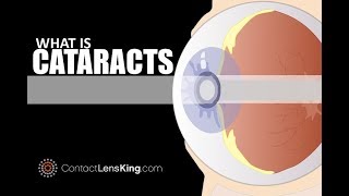 What Causes Cataracts  Symptoms and Treatments [upl. by Zoltai129]