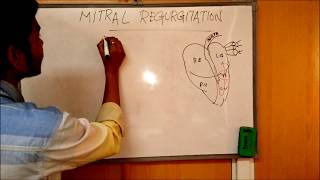 MITRAL REGURGITATION  DEFINITIONCAUSESSIGNSSYMPTOMSPATHOPHYSIOLOGY AND TREATMENT [upl. by Ymmas]