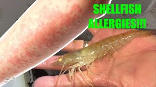 HAVING AN ALLERGIC REACTION WHILE COOKING SHELLFISH [upl. by Nolitta]