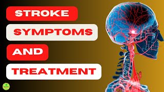 👉CAN WE PREVENT BRAIN HEMORRHAGE 【STROKE SYMPTOMS AND TREATMENT】 [upl. by Beichner]