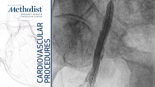 Common Femoral Angioplasty for Ulcerated Below Knee Amputation A Lumsden MD S Montelongo DO [upl. by Airtap949]