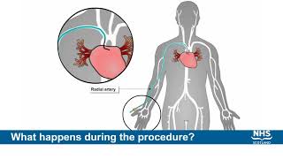 Coronary Angiogram Procedure [upl. by Nuli]