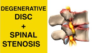 Sciatica Exercises  Stretches for Spinal Stenosis amp Degenerative Disc Disease Treatment [upl. by Nylodnarb]