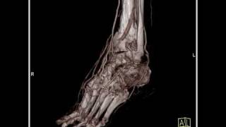 Vascular CT angiography of the lower extremity2 of 3 [upl. by Idolah356]