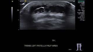 Knee Ultrasound Prepatellar Bursitis [upl. by Tareyn]