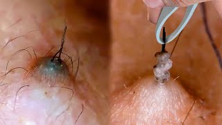 How to Prevent amp Treat Ingrown Hairs [upl. by Pike]