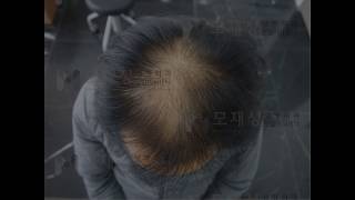 남성 헤어라인 정수리 비절개 모발이식 수술전후 영상 FUE Hair transplantation by Dr Moh [upl. by Ydal]