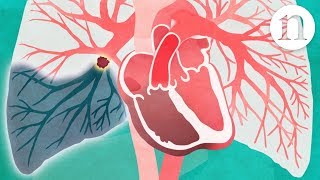 Pulmonary embolism The route to recovery [upl. by Romaine]