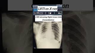 Typical example of LRTI on xray  lower respiratory tract infection doctor study students [upl. by Akenat741]