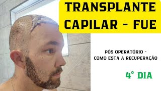 TRANSPLANTE CAPILAR  TÉCNICA FUE 4° DIA PÓS OPERATÓRIO [upl. by Crowley]