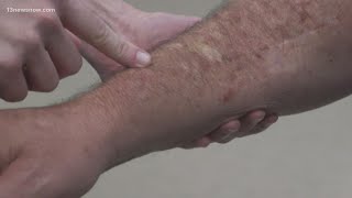 Skin Cancer How to spot melanoma warning signs [upl. by Osbourn]