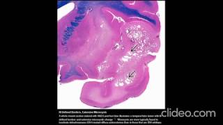 Diffuse Astrocytoma IDHMutant WHO Grade II [upl. by Pachton309]