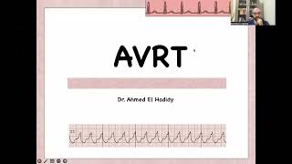 ECG course Lecture 20 AVRT [upl. by East209]