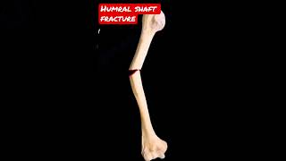 Humeral shaft fracture shorts [upl. by Kenzie]