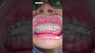 Dental Braces Adjustment  Ceramic Dental Braces Workflow  bracesadjustment dentalbraces braces [upl. by Derwin604]