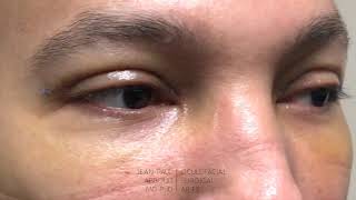 Upper Eyelid Blepharoplasty One Week After Surgery [upl. by Anerhs]