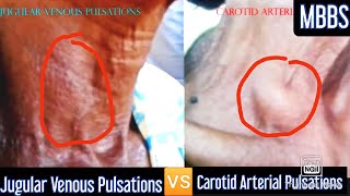 Jugular Venous Pulsations 🆚 Carotid Arterial Pulsations medicine mbbs cvs usmle neetpg [upl. by Pallas]