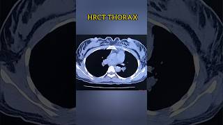 HRCT CHEST medicalimaging [upl. by Ttirrem]