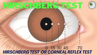 hirschberg corneal reflex tes  how to perform hirschberg test  hirschberg test explained [upl. by Raybourne]