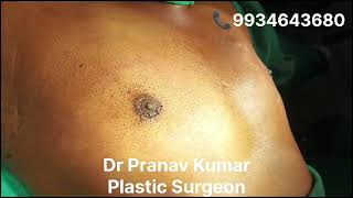 GYNECOMASTIA Grade 2 Immediate Postop ontable resultsDr Pranav Kumar Patna [upl. by Alyahsat]