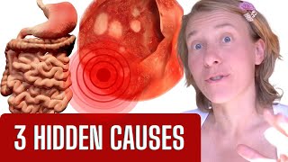 The Hidden Truth What REALLY Causes Gastritis SURPRISE [upl. by Wallas501]